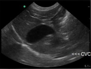 The classic starting point and depth at the AFAST DH view. Note the thin white (hyperechoic)line that represents the typical unremarkable gallbladder wall; and that adequate depth beyond the diaphragm allows the surveillance for pericardial effusion, the other major rule out to anaphylaxis in collapsed dogs for the gallbladder halo sign.