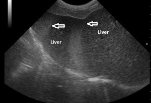 Echogenic-fluid-adjacent-to-liver-300x204